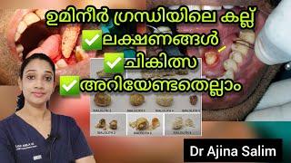 Sialolithiasis | Salivarygland stone | Stone in salivarygland | Health talk by Dr Ajina Salim