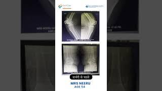 Total Knee Replacement Surgery | Patient Testimonial | Dr Himanshu Gupta