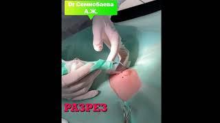 Видео удаления грудной железы при гинекомастии