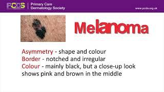 Melanoma & Other Skin Cancers - What To Look Out For