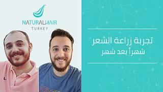 نتائج زراعة  الشعر شهر بعد شهر