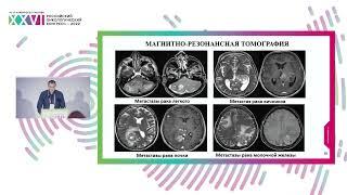 Диагностика метастатических опухолей головного мозга