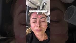 CO2 Laser for Skin Around the Eyelids | Butterfly Lift with Dr. Kami Parsa