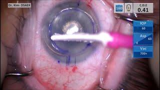 Refractive Cataract and Corneal Transplant Surgery: Toric IOL, Ultrathin DSAEK