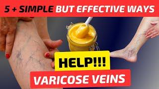 VARICOSE VEINS explained under 10 minutes | How to get rid of Varicose Veins at home?