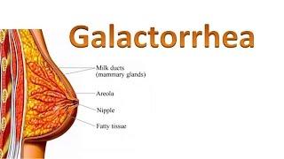 Galactorrhea