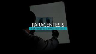 Paracentesis for Peritoneal Mesothelioma | Mesothelioma Hope