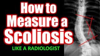 How to Measure a Scoliotic Curve 🩻#doctor #health #medical