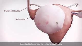 Laparoscopic ovarian cystectomy