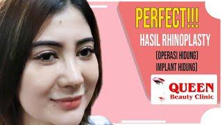 HASIL RHINOPLASTY (OPERASI HIDUNG) | BAGUS & PUAS | QUEEN KLINIK KECANTIKAN