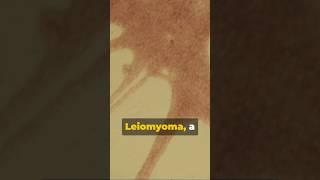 Leiomyoma Demystified:What You Need to Know #pathology #mbbs #2ndyearmbbs #femalereproductivesystem
