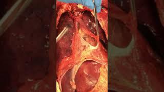 Autopsy: The Opening of the Pericardial Sac to Access the Heart