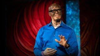 How I help people understand vitiligo | Lee Thomas