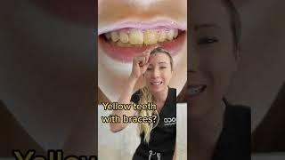 Yellow teeth with braces #orthodontics #braces #shorts