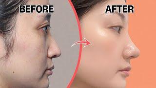 Rhinoplasty Before and After Review‼