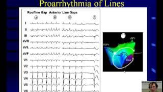 Atrial Fibrillation Ablation: Does Mapping Strategy Influence Outcomes?