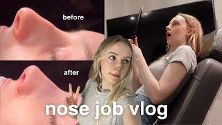 nose job vlog | rhinoplasty recovery & results