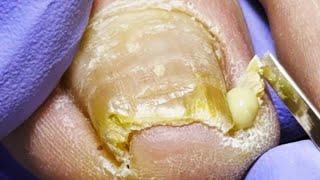 Wow ~ Crazy ingrown nails, leaking a lot of pus【Doctor Liu Pedicure】