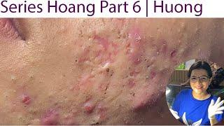 Acne Treatment Huong Da Nang# 023 | Series 6 Hoang  Loyal fans