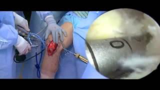 Posterior Cruciate Ligament Reconstruction: Femoral Tunnel Anatomic Localization and Creation