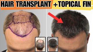 The BEST Treatment For Hair Loss HT+Fin - Choiexpert