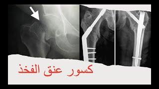 Femoral neck Fracture / كسور عنق الفخذ