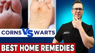 Plantar Warts vs Corns vs Calluses [TOP 20 BEST Home Remedies]