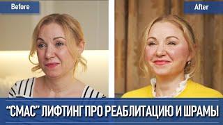 СМАС лифтинг шрамы и реабилитация, все как есть