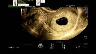 Early pregnancy 6 weeks normal intrauterine (Dr Wiku Andonotopo)