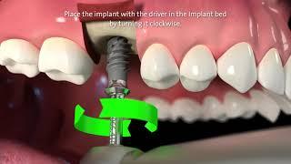 Straumann® TLX Implant System Step by Step