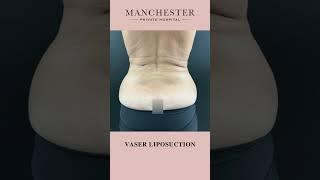 Vaser Liposuction Before and After Results by Mr Anuj Purbey