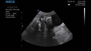 Bladder stone on ultrasound