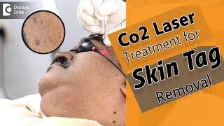 Skin Tag Removal in seconds using Cardondioxide Laser | Procedure - Dr. Rajdeep Mysore