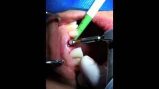 Implante Imediato Rápido - Implante Dentário na hora da extração | São Paulo-SP