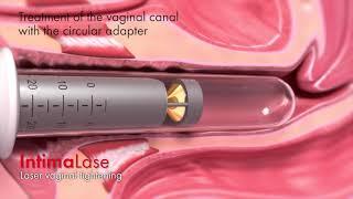 Intimalase - Laser Vaginalstraffung
