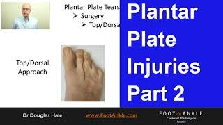 Plantar Plate Injuries - Part 2 | Seattle Podiatrist