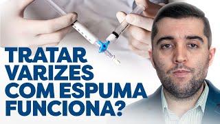 Mitos e verdades ao tratar varizes: cirurgia, espuma, laser, qual é melhor? Varizes podem voltar?