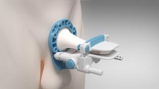 Development of the RestoreX Penile Traction Device