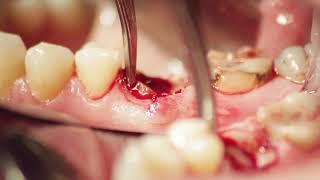 LM-LiftOut™ - Luxating Instruments for Atraumatic Extraction