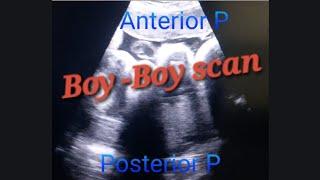 Boy-Boy Scan @ anterior & posterior Placenta | Genderreveal Fraternal Twins | Diamniotic Dichorionic