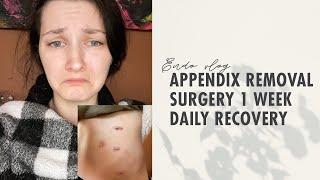 Appendix Removal Surgery 1 Week Daily Recovery