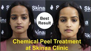 Take Advantage Of Chemical Peel Treatment at Skinaa Clinic