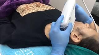 (RJ Clinic) How to choose the best Non-surgical Facelifting