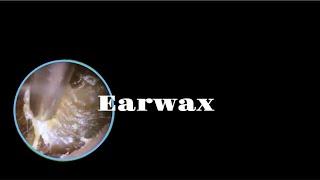 Earwax from here2.0#earwax #earwaxremoval #foryou #fypyoutube #asmr