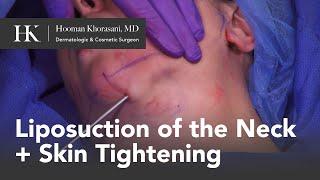 Liposuction of the Neck + Sub Dermal Skin Tightening using JPlasma