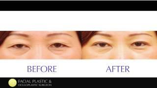 #ChaseLayMD Asian Eyelid Surgery 03