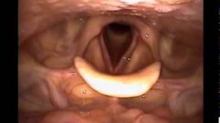 Acute Laryngitis