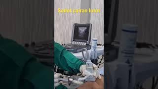 Nyeri lutut! Cairan di lutut akibat pengapuran/osteoartritis dapat dikeluarkan tanpa operasi