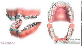 Orthodontic Treatment - Extraction of First Premolars