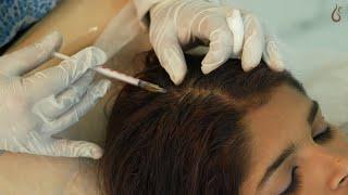 GFC for hair growth #hair #gfctreatment #hairloss #hairfall #hairfallsolution #hairlosstreatment